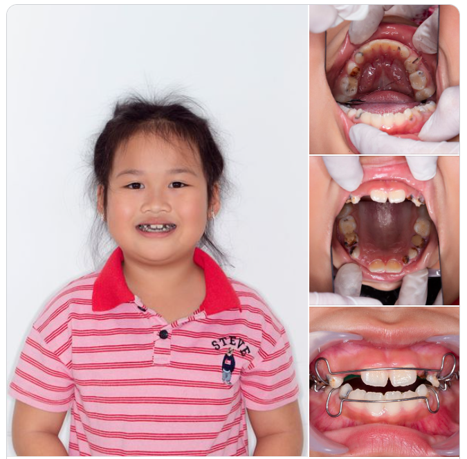 MẸ ƠI! RĂNG CON THẾ NÀY, PHẢI TIỀN CHỈNH NHA MẸ NHÉ!