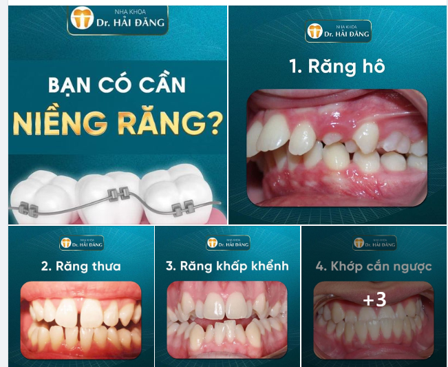 Bạn có thuộc những trường hợp cần niềng răng