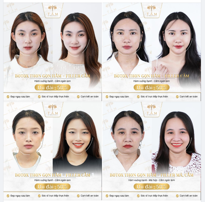 COMBO THĂNG HẠNG NHAN SẮC "BOTOX HÀM + FILLER CẰM"