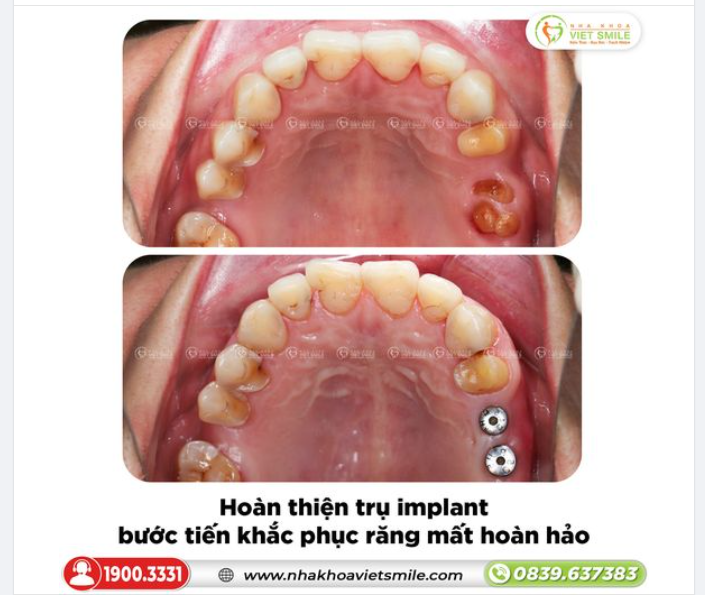 HOÀN THIỆN TRỤ IMPLANT, BƯỚC TIẾN KHẮC PHỤC RĂNG MẤT HIỆU QUẢ