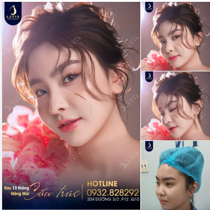 Sau hơn 1 năm nâng mũi, em có gì Thứ mà em có là diện mạo xinh đẹp và thần thái tự tin như ngày hôm nay.