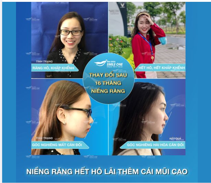 NIỀNG RĂNG HẾT HÔ, LÃI NGAY THÊM CHIẾC MŨI CAO!
