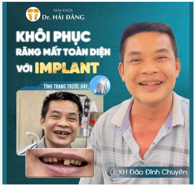 KHÔI PHỤC RĂNG MẤT TOÀN DIỆN VỚI IMPLANT