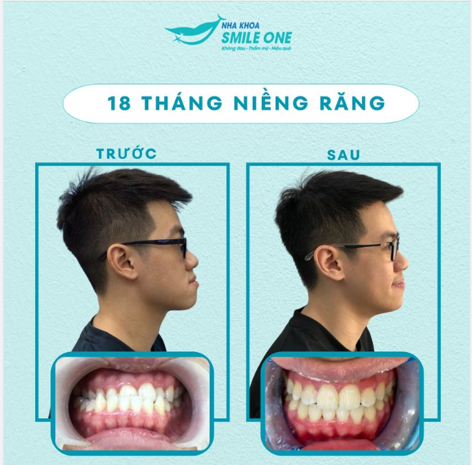 Răng móm là tình trạng răng hàm dưới nhô ra lệch so với xương hàm trên, làm cằm bị lệch và khuôn mặt mất hài hòa ảnh hưởng đến thẩm mỹ, ngại giao tiếp,..