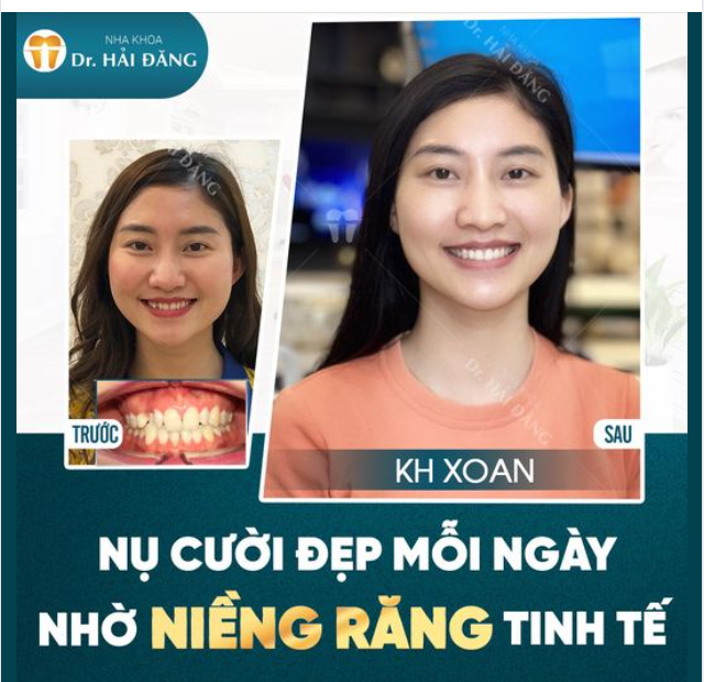 NỤ CƯỜI ĐẸP MỖI NGÀY NHỜ NIỀNG RĂNG TINH TẾ