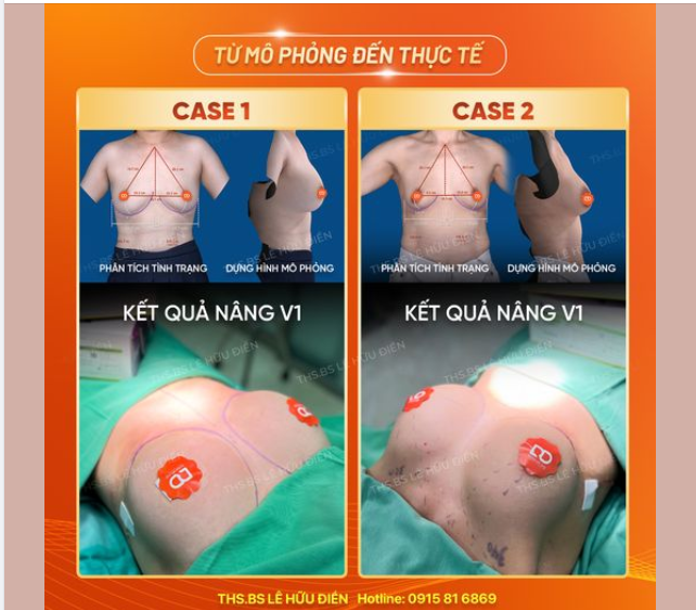 TỐI ƯU HOÁ LỰA CHỌN SIZE NGỰC BẰNG CÔNG NGHỆ CỦA "TƯƠNG LAI" VECTRA XT PLUS