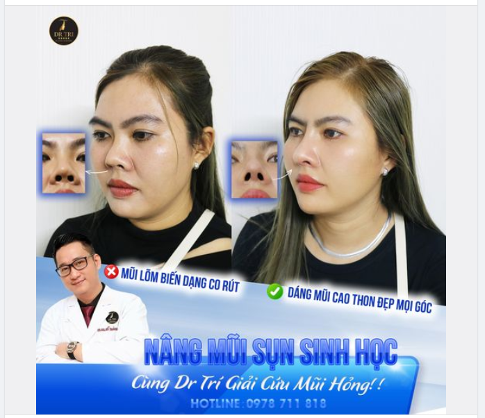 CÙNG DR TRI GIẢI CỨU MŨI LÕM, CO RÚT, BIẾN DẠNG