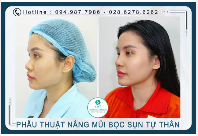 Không có một dáng mũi chuẩn cho tất cả mọi người mỗi sóng mũi đều được chúng tôi điêu khắc riêng cho phù hợp nhất voi gương mặt bạn, vừa cao đẹp vừa phải hài hoà.