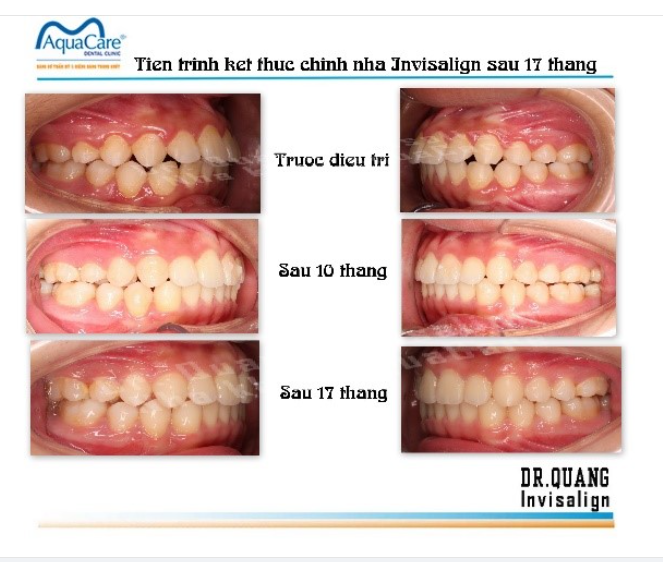 BIẾT BAO NĂM ĐỢI, THÁNG CHỜ