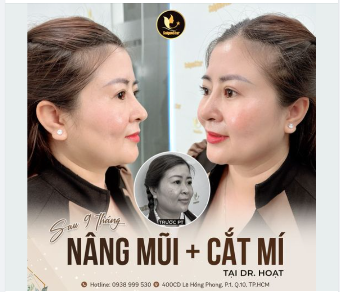FEEDBACK SAU 9 THÁNG NÂNG MŨI + CẮT MÍ