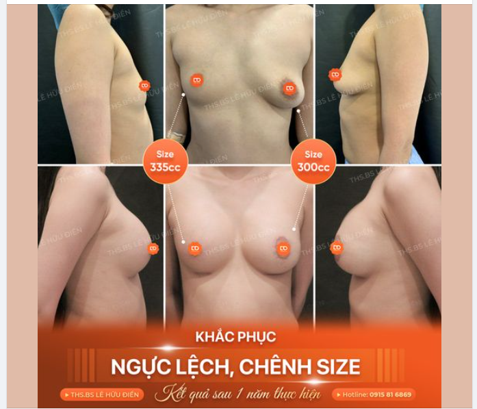 V1 KHÁC "1 TRỜI 1 VỰC" SAU KHI NÂNG NGỰC 1 NĂM TẠI DrD
