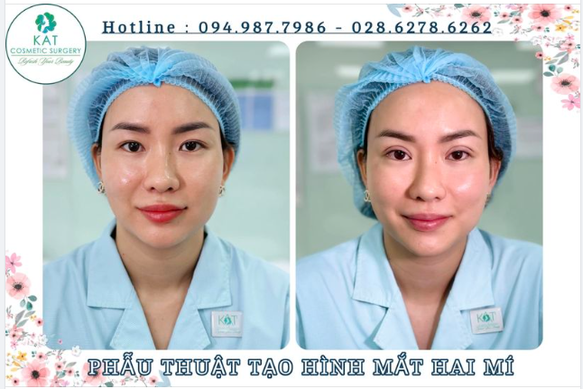 Trên 30 tuổi có nhấn mí được không? - Câu hỏi được rất nhiều chị em thắc mắc