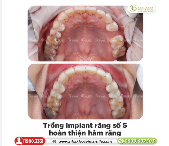 TRỒNG IMPLANT HOÀN THIỆN RĂNG HÀM, THOẢI MÁI ĂN NHAI