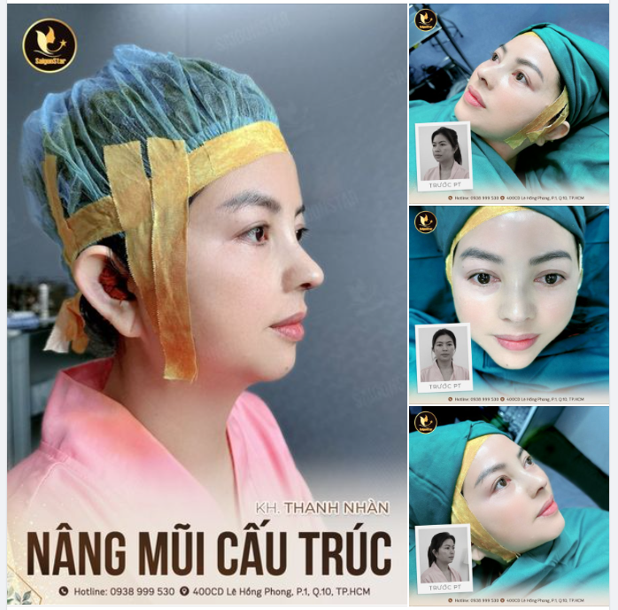 CẬP NHẬT KẾT QUẢ NÂNG MŨI CẤU TRÚC KH. THANH NHÀN