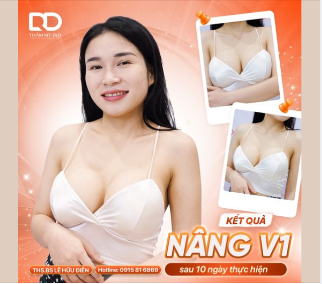 KIẾN TẠO V1 VỚI NÂNG NGỰC NANO CHIP ERGONOMIX