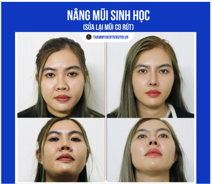 CỨU CHỮA MŨI HỎNG- GIẢI QUYẾT BIẾN CHỨNG