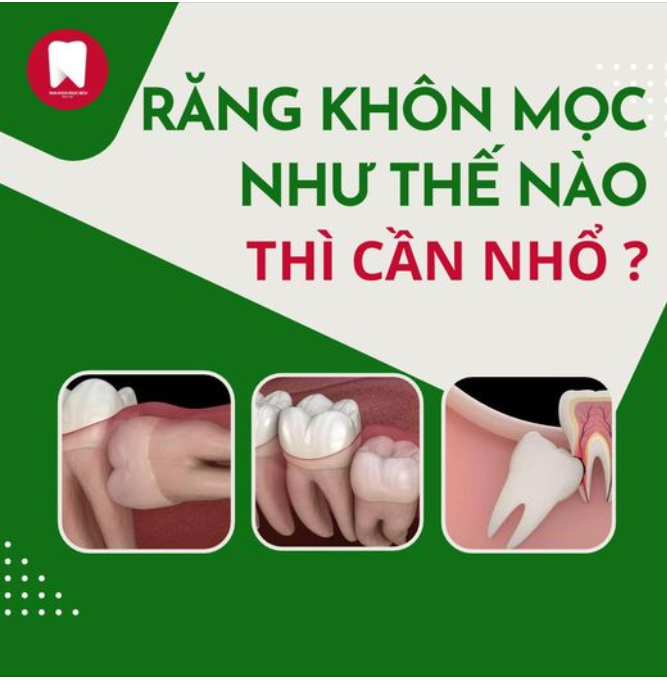 RĂNG KHÔN MỌC NHƯ NÀO THÌ CẦN NHỔ ?
