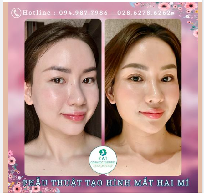 Feedback từ Khách hàng là một cô chủ chuỗi Spa nổi tiếng Sài Gòn sau khi nhấn mí được 1 tháng .