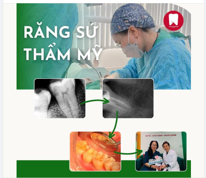ĐIỀU TRỊ TỦY RĂNG SÂU THẨM MỸ RĂNG SỨ