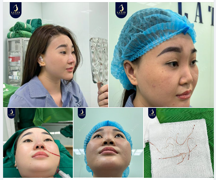 Cứ nghĩ nâng mũi chỉ vừa tiết kiệm, vừa đẹp, CÓ NGỜ ĐÂU!