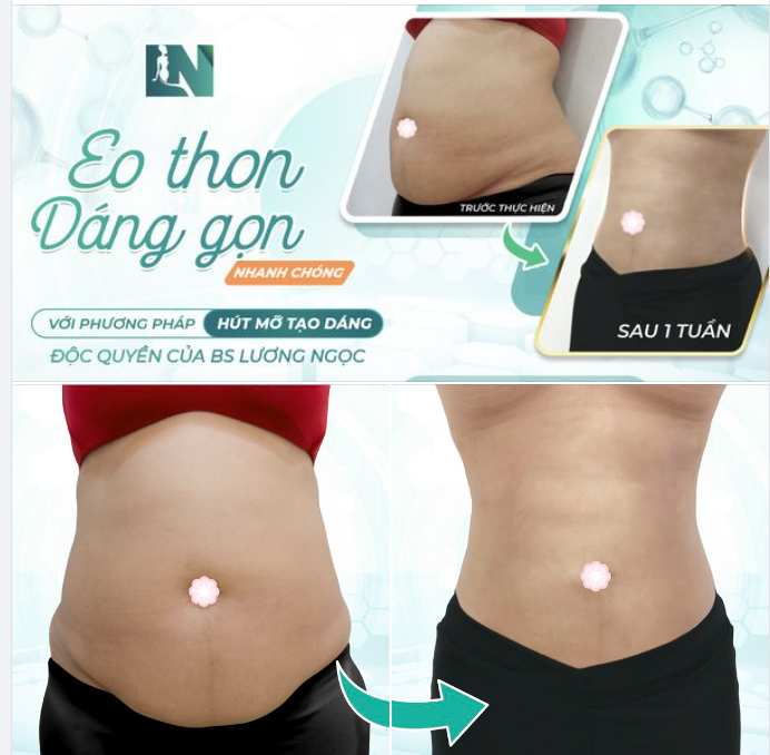 SỞ HỮU VÒNG EO THON GỌN TỰ TIN VÀ SỨC KHỎE TUYỆT VỜI - HÚT MỠ TẠO DÁNG CÙNG BS. LƯƠNG NGỌC