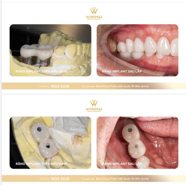 Phục hình 2 răng cối lớn hàm dưới với 2 trụ Implant Straumann (Thụy Sĩ) và răng sứ nguyên khối Orodent High Translucent