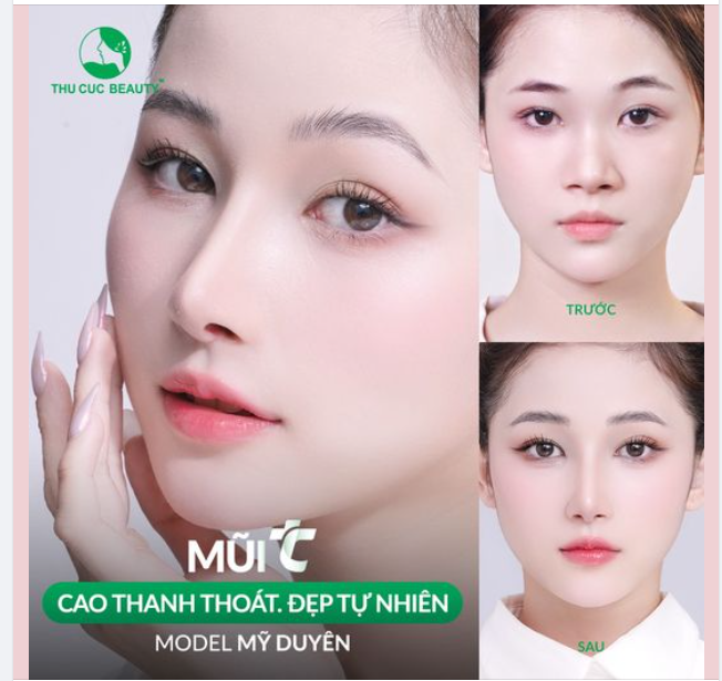 Duy nhất 5 suất -35% Mũi  đẹp ngay đón Đại lễ cùng Thẩm Mỹ Thu Cúc