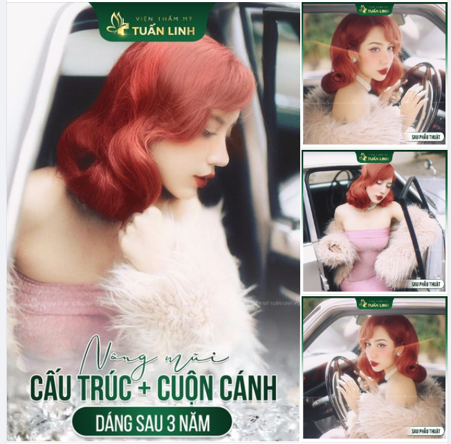 Mách bạn bí quyết để có gương mặt xinh tươi, sang chảnh Nâng mũi cấu trúc chỉ với 29TR500 Tặng ngay suất filler môi