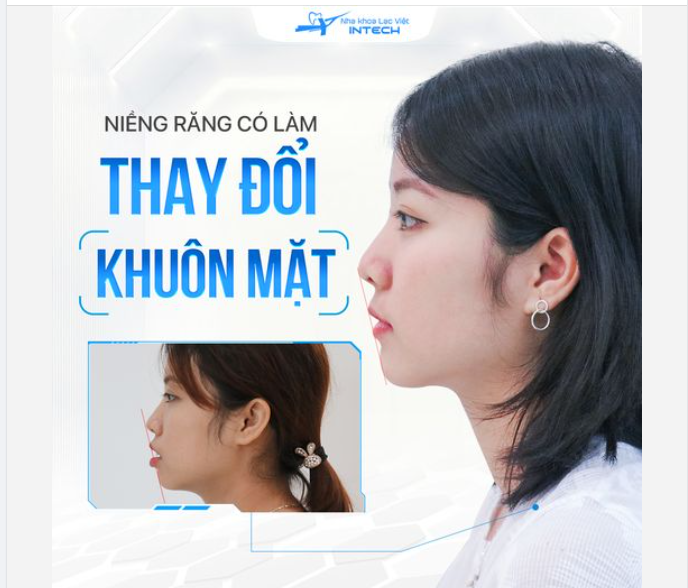 NIỀNG RĂNG THAY ĐỔI KHUÔN MẶT - SỰ THẬT HAY CHỈ LÀ LỜI QUẢNG CÁO “CÓ CÁNH”?