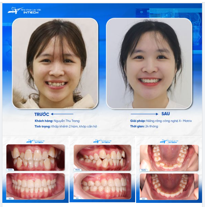 NIỀNG RĂNG XONG KHÔNG AI NHẬN RA VÌ … QUÁ XINH!