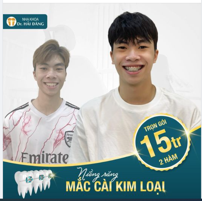 NIỀNG RĂNG MẮC CÀI KIM LOẠI ƯU ĐÃI SIÊU LỚN