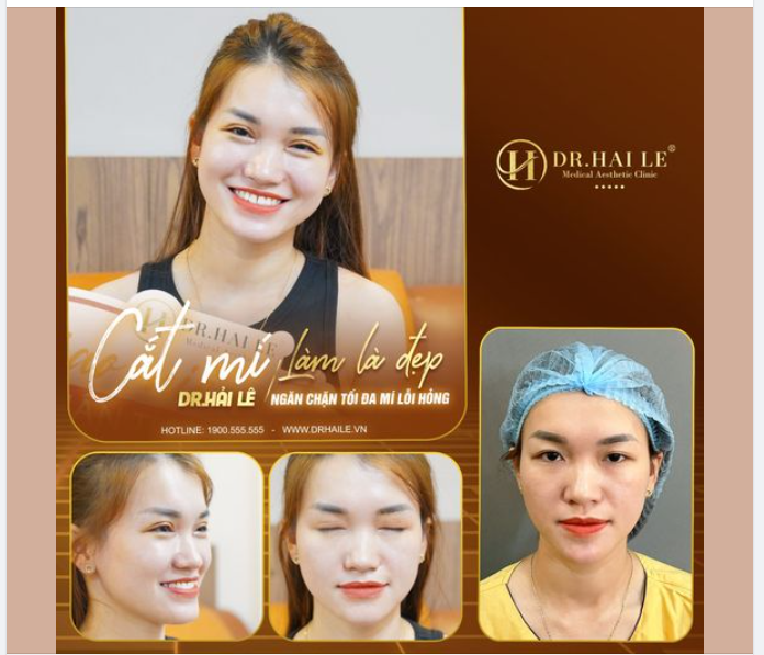 Tóp 5 lý do bạn nên chọn cắt mí tại DR Hải Lê