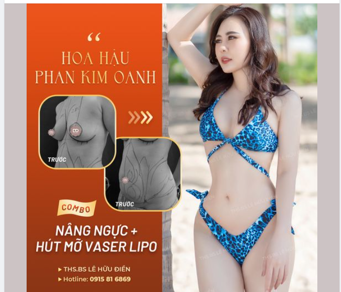 COMBO NÂNG NGỰC + HÚT MỠ VASER LIPO = TẠO HÌNH BODY ĐẸP MIỄN CHÊ