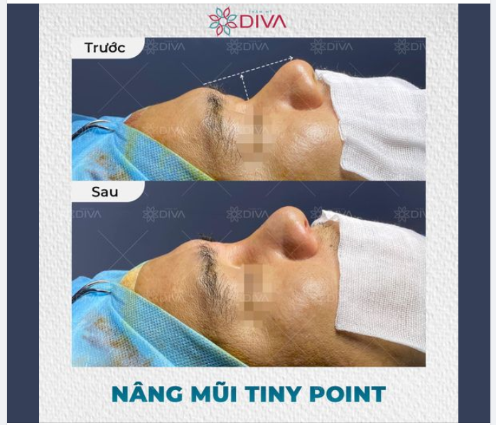 NAM GIỚI SÓNG MŨI THẤP, GÃY NGANG MẮT – GIẢI PHÁP LÀ GÌ?