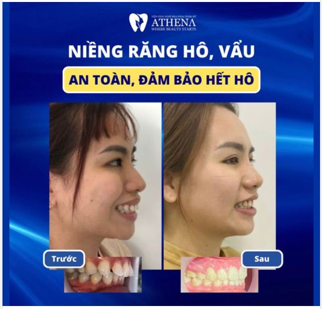RĂNG BỊ HÔ - NIỀNG RĂNG CÓ HẾT KHÔNG?