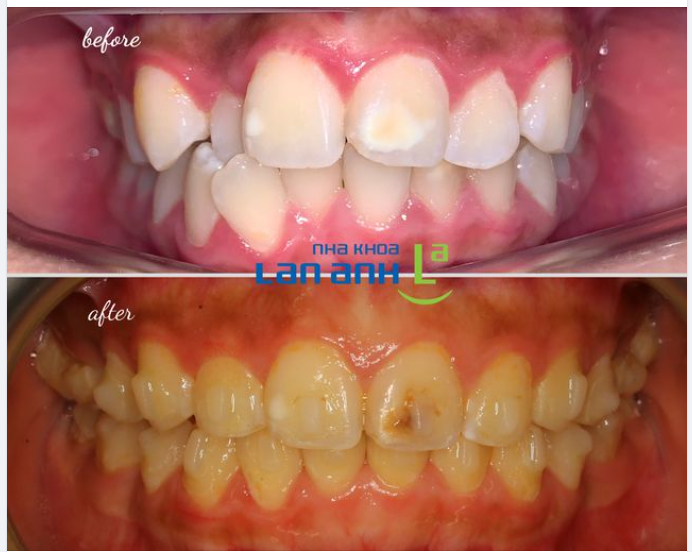 Niềng răng Invisalign: kết quả vẫn tốt kể cả những trường hợp răng lệch lạc nhiều nhé!