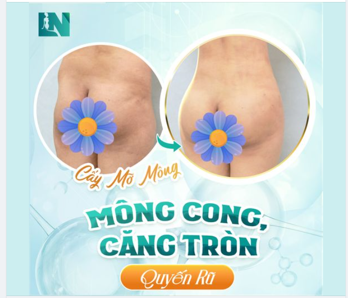 NÂNG CẤP VÒNG 3 CĂNG TRÒN, ĐẦY ĐẶN BẰNG MỠ TỰ THÂN