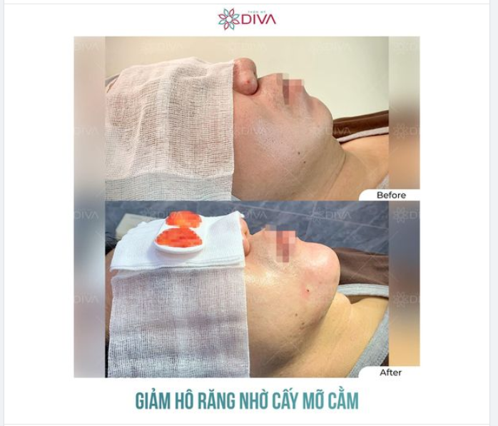 CẤY MỠ COLEMAN CẰM LÀM GIẢM HÔ MIỆNG?
