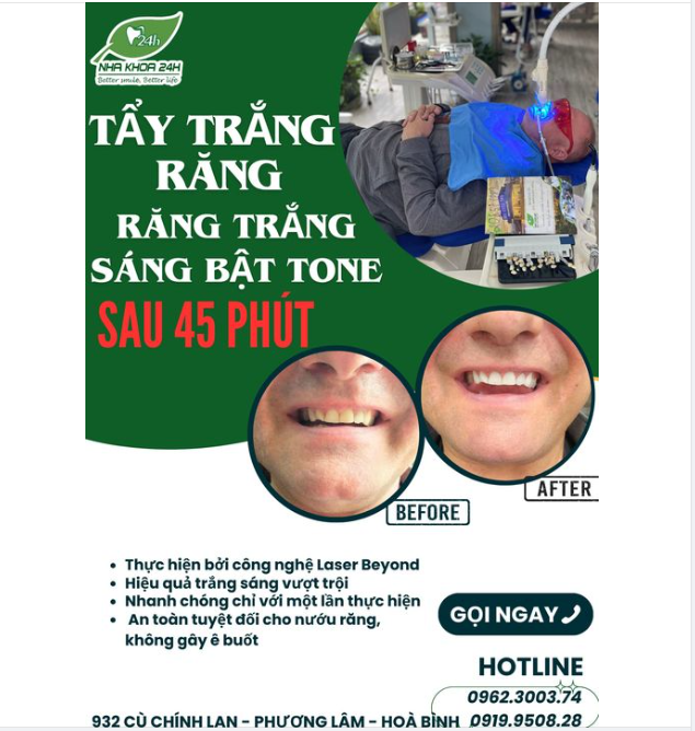 Tẩy trắng răng toàn diện- Răng trắng bật tone sau 45 phút