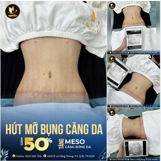 Chị khách sau khi con cai sữa đã đến ngay Saigon Star để thực hiện tân trang vòng 2.