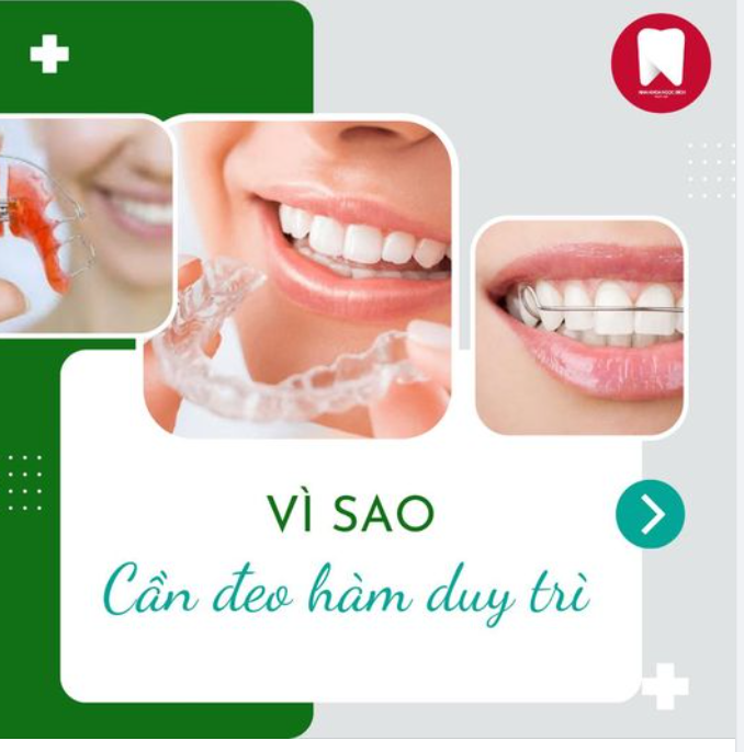 ️ĐEO HÀM DUY TRÌ - DUY TRÌ VẺ ĐẸP BỀN BỈ SAU NIỀNG RĂNG