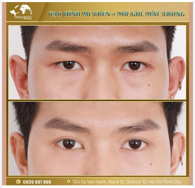 Sự lột xác của Khách hàng nam sau 3 tháng Tạo hình mí mắt trên kết hợp mở rộng góc mắt trong tại Thế Giới Đẹp!