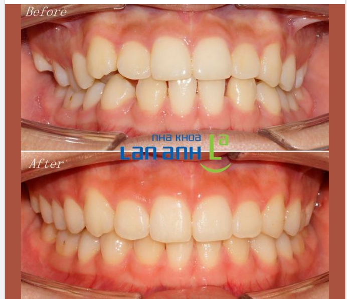 Niềng răng tại nha khoa Lan Anh, kết quả ổn định, bền vững lâu dài!