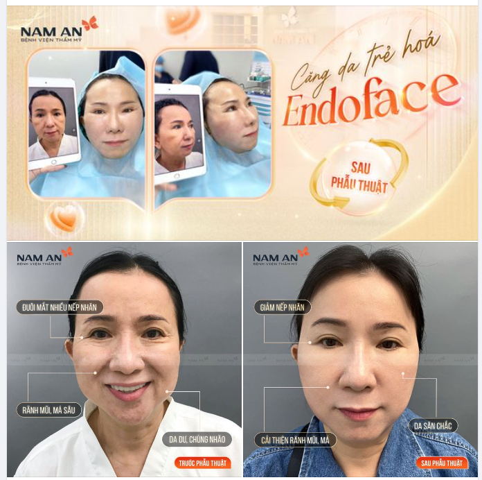 CĂNG DA NỘI SOI ENDOFACE - TRẺ HÓA TOÀN DIỆN