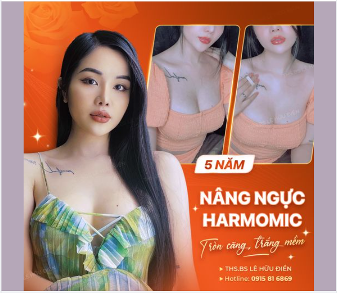 "Đốt mắt" với V1 sau 5 năm thực hiện Nâng ngực tại DrD.