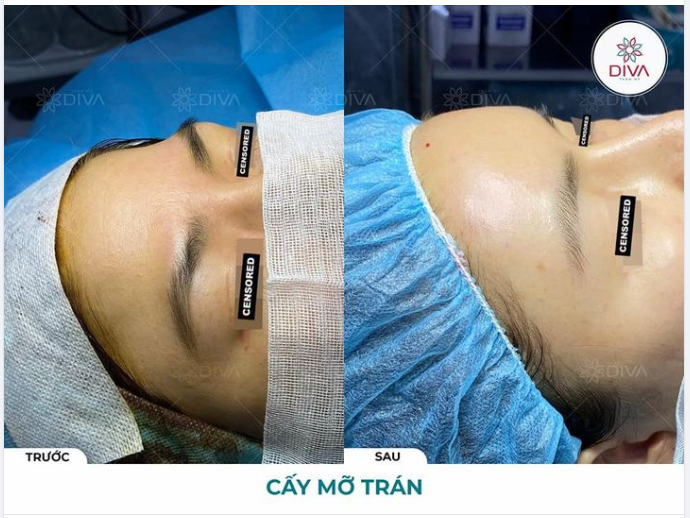SAU TIÊM MỠ TRÁN CÓ ĐẸP NGAY KHÔNG?