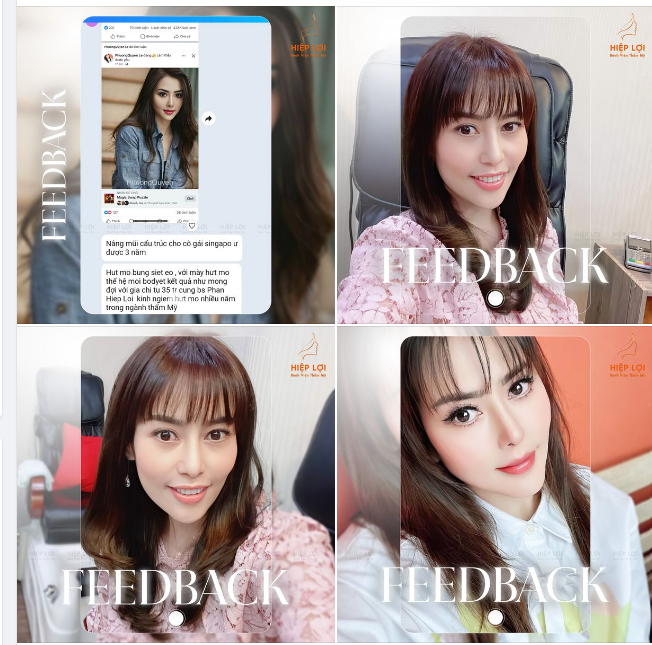 Visual sau 3 năm nâng mũi cực xinh của chị khách