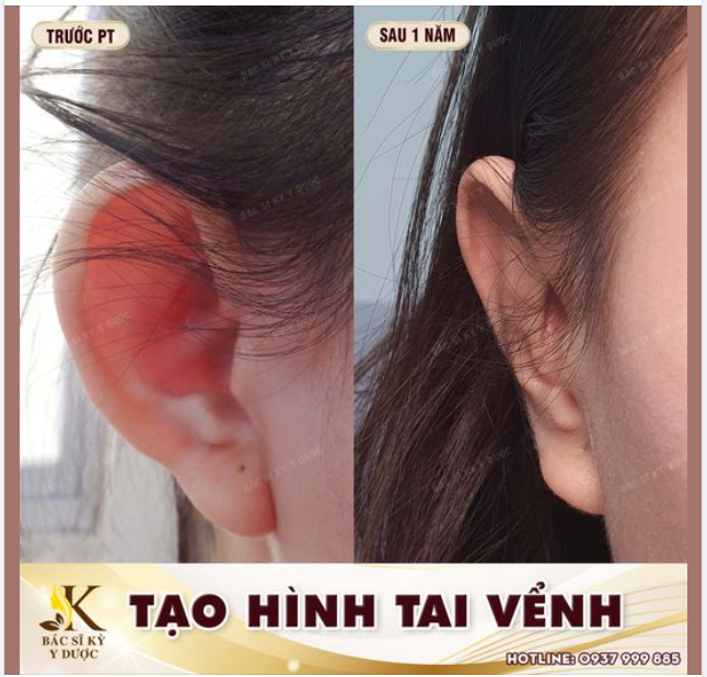 Phẫu thuật chỉnh hình tai vểnh là gì?
