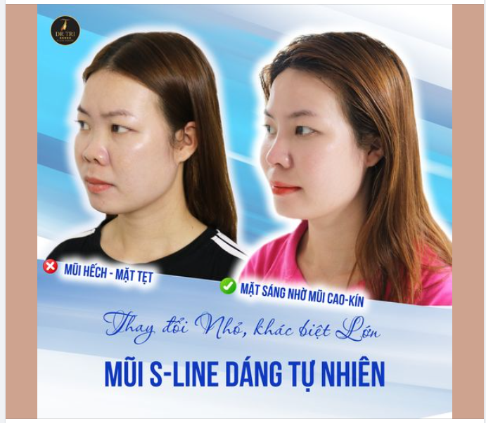 KÉO DÀI MŨI HẾCH- MẶT SÁNG NÉT SANG