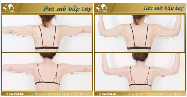 Có ngay vẻ đẹp "mình hạc xương mai" sau 1 lần ph.ẫu th.uật hút m.ỡ bắp tay bằng công nghệ Châu Âu!